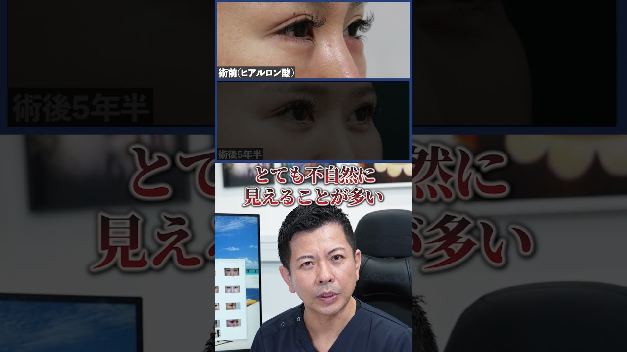 【5年後もパッチリ】綺麗な涙袋はヒアルロン酸よりも"クマ治療"で作れ！