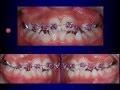 Fixed Orthodontic Appliances in the Mixed Dentition