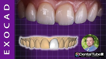 How to use Mirror Tool in Exocad Tutorial