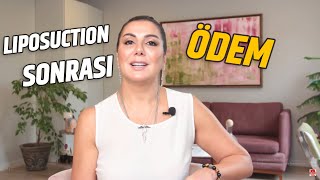 LIPOSUCTION (LİPOSAKŞIN) SONRASI ÖDEM NASIL GEÇER?! | Op. Dr. Leyla Arvas Resimi