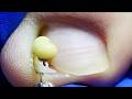 Wow~ The Toenails Are Sick And Inflamed~【Xue Yidao】
