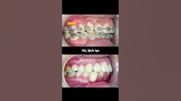 Cận cảnh quá trình niềng răng hô và lệch lạc tại Up Dental