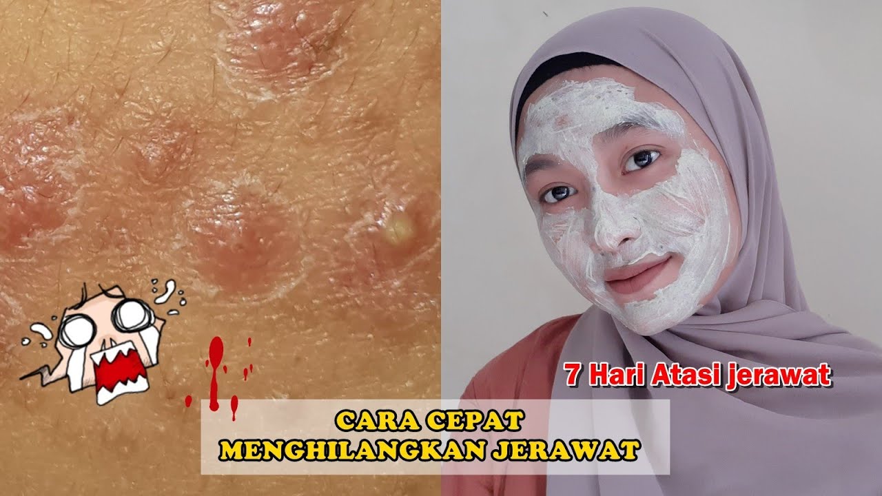 CARA MENGHILANGKAN JERAWAT CUMA 7 HARI AJA!!! - YouTube