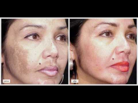 4%-hydroquinone-cream-for-discoloration,-melasma,-skin-lightening-and-pregnancy-mask
