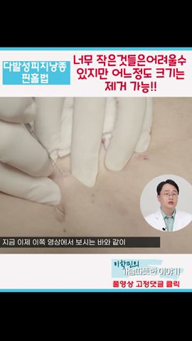 다발성피지낭종