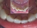 Facettes dentaires sur les dents du bas mode demploi