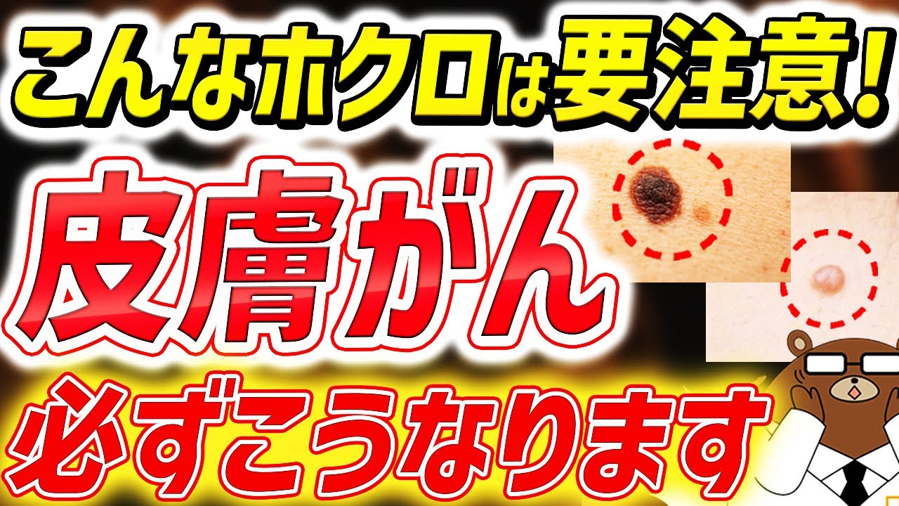 【紫外線が危険】日本で激増している皮膚がんの超意外な初期症状とは。なる人の共通点は。体のこんな「ほくろ」は絶対見逃さないで！皮膚がんの「ABCDEサイン」とは。予防法は？医師が徹底解説！