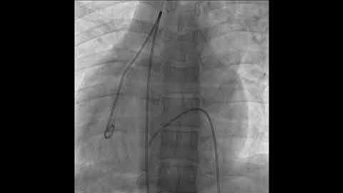 SS/DC - CTGA VSD - RV ANGIOGRAM