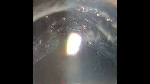 Como é o procedimento YAG Laser?