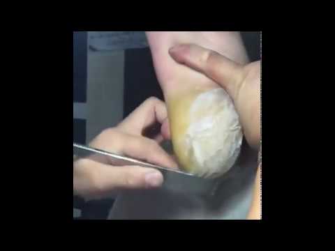 Extreme Ingrown Toenail Causes Problem That Needs To Be Removed Tutorial