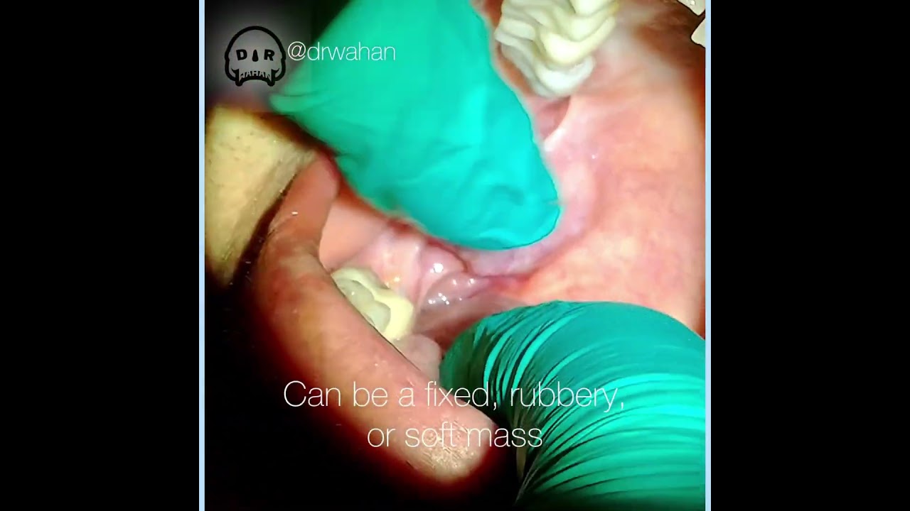 Rare Presentation of Mucoepidermoid Carcinoma: Oncocytic Variant from a Minor Salivary Gland