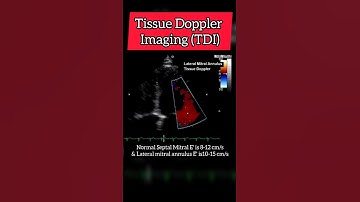 Tissue Doppler Imaging (TDI) Echocardiography For Beginners #echocardiogram #heart #cardiology