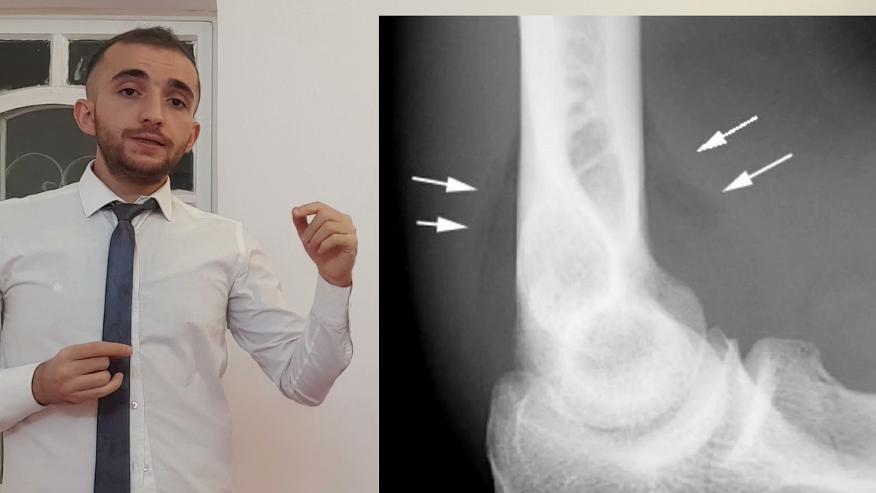 UL: Supracondylar fracture l كسر فوق اللقمة