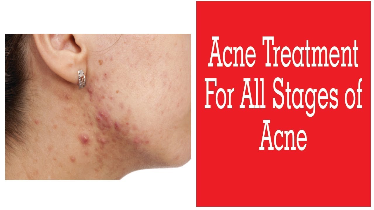 Acne Treatment For All Stages Of Acne Dr. Rinky Kapoor YouTube