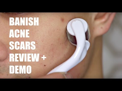 ACNE SCAR REMOVAL | BANISH ACNE SCARS DEMO + REVIEW