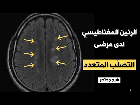 الرنين المغناطيسي لدى مرضى التصلب المتعدد ( شرح مختصر )