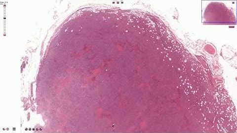 Diffuse Large B-Cell Lymphoma - Histopathology