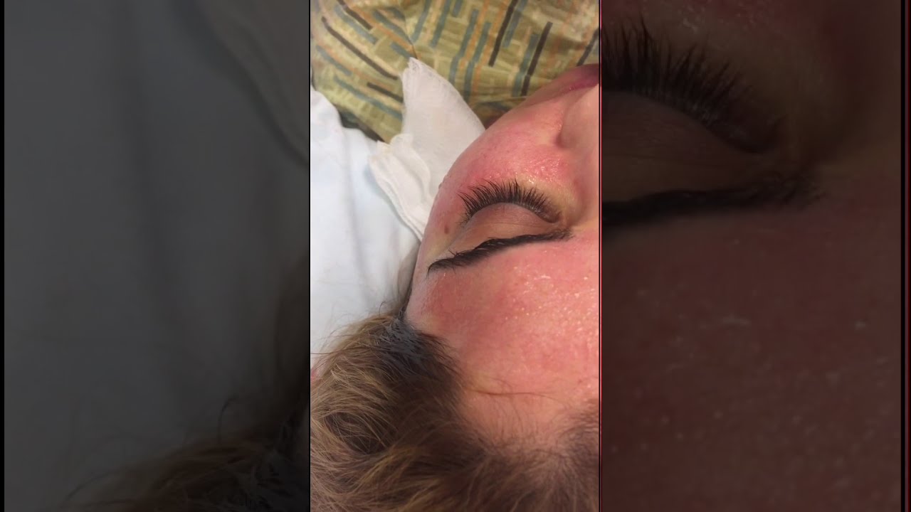 Fractora for Skin Rejuvenation + Acne Scar Treatment