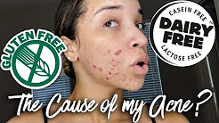 Acne Update #1 | My Food Allergies