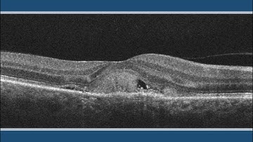 Subretinal Hyperreflective Material (SHM)