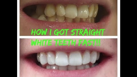 My Inman Aligner experience! how i straightened my teeth!