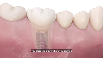 Incorporating a digital implant workflow into practice