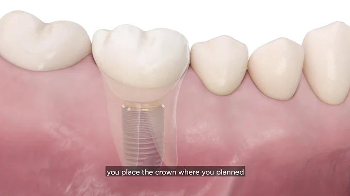 Incorporating a digital implant workflow into practice