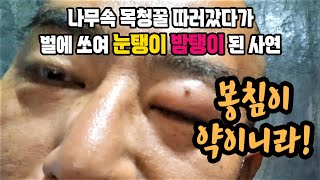 눈탱이 밤탱이!! 봉침이 약이니라!