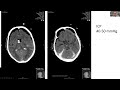 Eans webinars coagulation management in traumatic brain injury
