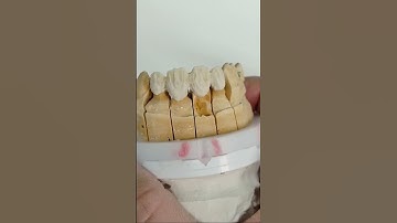 Zirconium bridge build up #teeth #dental #handmade