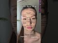 #acne #acnetreatment #acneskin #koreanskincare #skincaretips