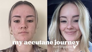 My Accutane Journey: 6 months on Accutane