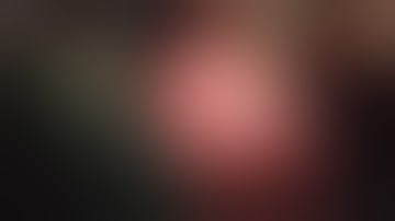 Mandibulectomy with fibula graft