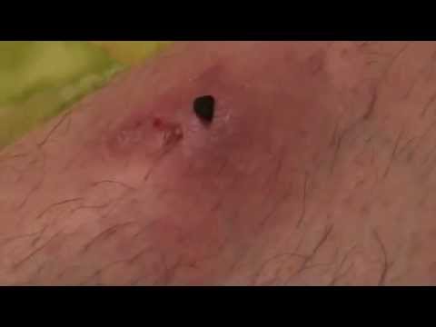 HUGE Splinter In My Leg Story