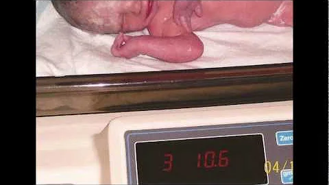 Trisomy 18 In memory of Alison White
