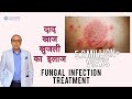 फ़ंगस इनफ़ेक्शन (दिनाय, दाद, खाज) का इलाज | Treating Fungal Infection (In HINDI) | Dr Rohit Batra