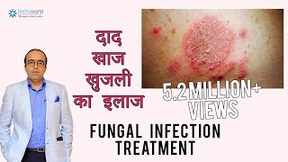 फ़ंगस इनफ़ेक्शन (दिनाय, दाद, खाज) का इलाज | Treating Fungal Infection (In HINDI) | Dr Rohit Batra