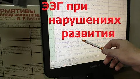 ЭЭГ при задержках речи и развития: когда нужна, что показывает и расшифровка