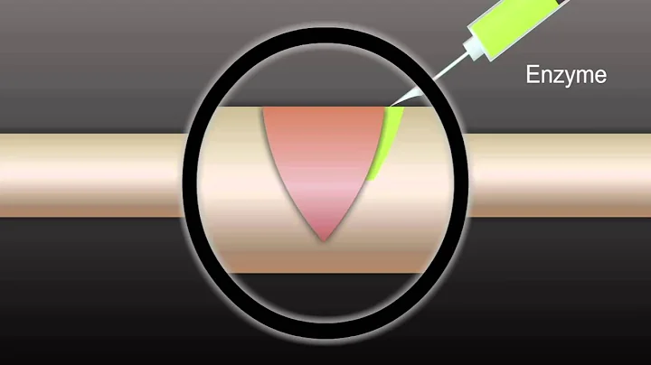 Restoring breathing after spinal cord injury