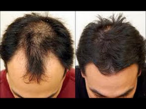 PERLU DIKETAHUI 10 Cara  Menumbuhkan  Rambut  Botak dengan  