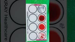 blood group test ✅ #pathology