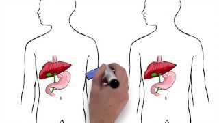 Gallstones can be treated by scarless robotic surgery