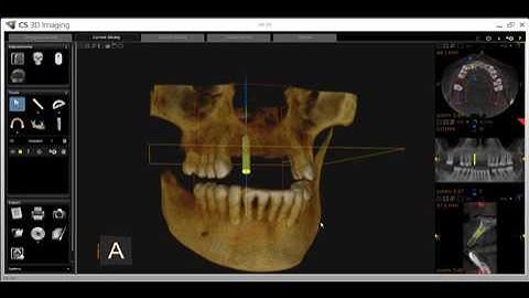 CS 3D Imaging   Implant Functionality & the Implant Library