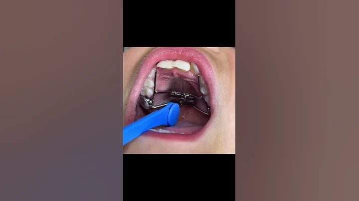 How to Activate an Expander #shorts #expander