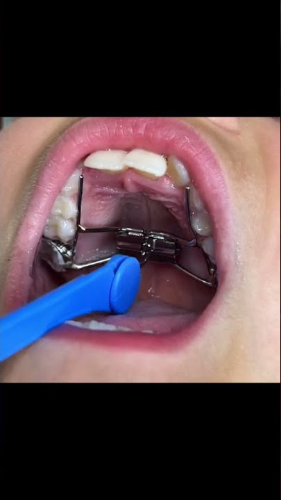How to Activate an Expander #shorts #expander