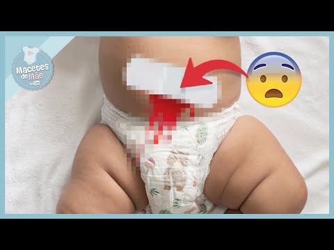 Vídeo: O cordão umbilical sangra ao cair?