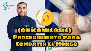 Procedimiento para Combatir el Hongo (Onicomicosis)