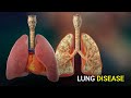 COPD: the 4th Deadliest Disease in the World