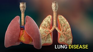 Copd: The 4Th Deadliest Disease In The World