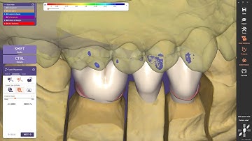Instant Anatomic Morphing in DentalCAD Galway